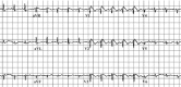 Figure 1. . Characteristic ECG in Brugada syndrome.