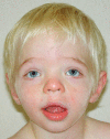 Figure 1. . AP view of a boy age two years with CLS showing relatively fine facial features but with widely spaced eyes, mildly downslanted palpebral fissures, short nose with broad columella and thick, slightly everted vermilion of the lips.
