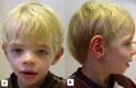 Figure 2 A & B. . AP and lateral view of the same boy at age five years showing a more triangular-shaped face, increasing coarseness, and expression of the typical facial signs of CLS.