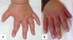 Figure 4 A & B. . Hand of the child illustrated in Figure 1 and Figure 2 at ages two years (A) and five years (B).