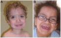 Figure 2. . Typical facial features seen in an 8-year old white boy (A) and a nearly 11-year-old Hispanic girl (B) with Costello syndrome Gripp & Lin [2012].