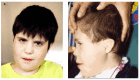 Figure 1. . Two unrelated children showing microbrachycephaly, straight eyebrows, deeply set eyes, wide and depressed nasal bridge, midface retrusion, elongated philtrum, pointed chin, and hypotonic face A.