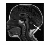 Figure 2. . MRI of cerebellar hypoplasia in an individual with the Hoyeraal Hreidarsson variant of dyskeratosis congenita.