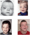 Figure 1. . Face: same male with Donnai-Barrow syndrome over time A.