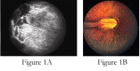 Figure 1.. Classic features of FEVR 1A.