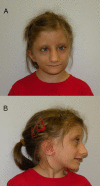 Figure 1. . Facial appearance of an 11-year-old girl with FHS (SRCAP pathogenic variant p.
