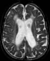 Figure 4. . Axial T2-weighted image in a 15-year-old shows enlargement of ventricles and subarachnoid spaces consistent with cerebral atrophy.