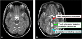 Figure 1. . Molar tooth sign in Joubert syndrome A.