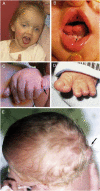 Figure 2. . Clinical features in JSRD A.