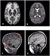 Figure 1. . Brain images of an individual with MLC (A, C) and an unaffected individual (B, D) A.