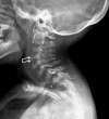 Figure 6. . Lateral cervical spine x-ray of a female age six years with MPS IVA.