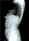 Figure 7. . Lateral spine x-ray of a female age eight years with MPS IVA.