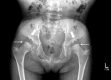 Figure 8. . Hip x-ray of a female age eight years with MPS IVA.