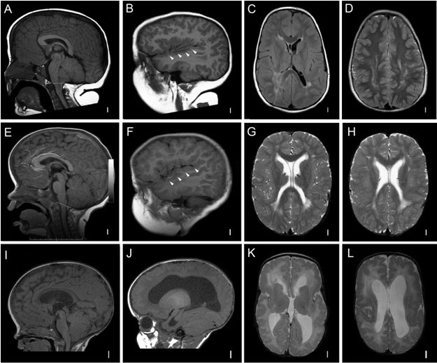 Figure 3. . Features of MCAP syndrome.