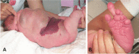 Figure 4. . Characteristic brain MRI of MCAP syndrome in three individuals (A-D, E-H, and I-L).