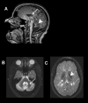 Figure 1. .
                                MRI of the brain of an individual with
                                molecularly confirmed 4H syndrome A.