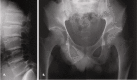 Figure 1. . Radiographs of a 31-year-old male with SEDT A.