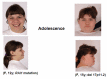 Figure 3. . Adolescent females with Smith-Magenis syndrome caused by RAI1 mutation (left) and deletion 17p11.