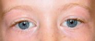 Figure 1. . Note the stellate iris pattern in an individual with Williams syndrome.