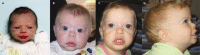 Figure 3. . Young children with Williams syndrome typically have epicanthal folds, full cheeks, and small, widely spaced teeth as seen in these children at the following ages: A, newborn; B, 10 months; C and D, 21 months.