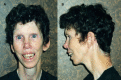 Figure 4. . Adults typically have a long face and neck, accentuated by sloping shoulders, resulting in a gaunt appearance, as seen in this 43-year-old affected individual.
